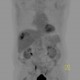 Liver metastasis of adenocarcinoma of colon, colorectal carcinoma, biopsy: NM - Nuclear medicine